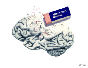 آلزایمر