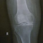 اضطراب موجب افزایش احتمال شکستن استخوان می شود