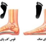 کف پای صاف و معرفی چند حرکت ساده  اصلاحی جهت پیشگیری و درمان